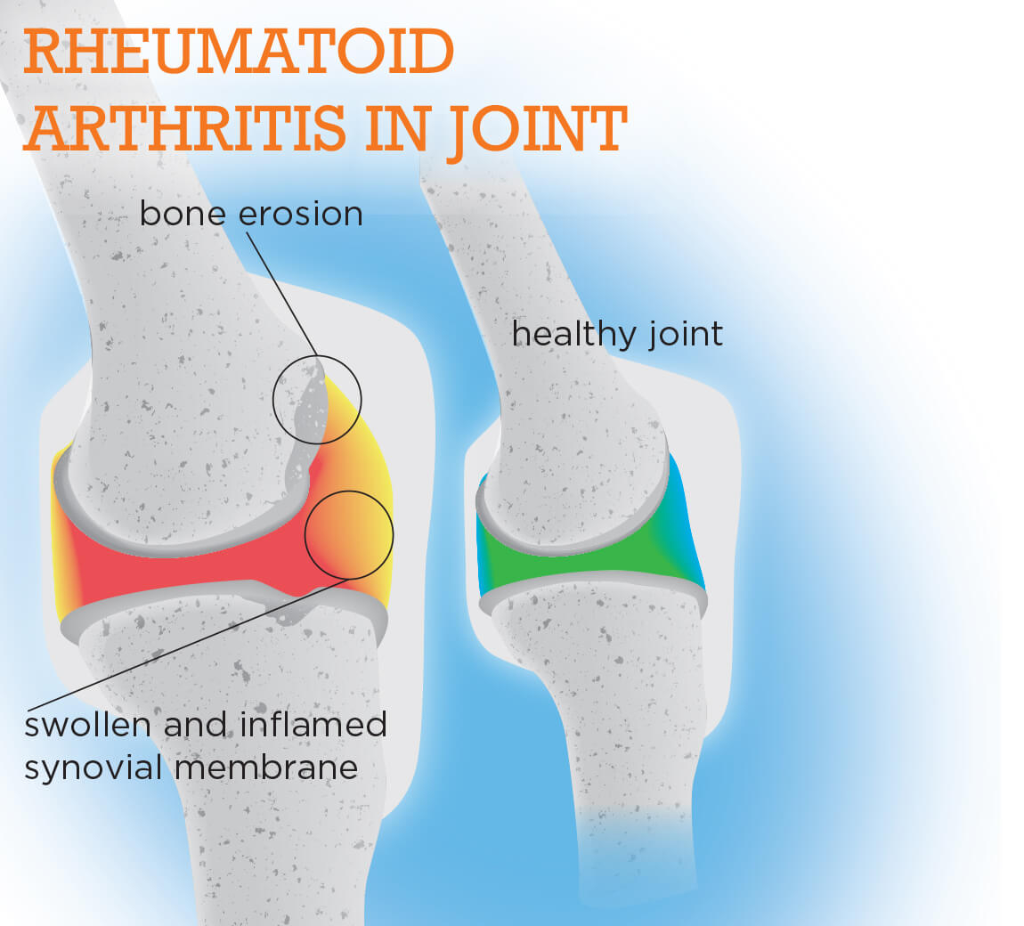 Exciting Breakthroughs in Preventing Rheumatoid Arthritis Benaroya Research Institute